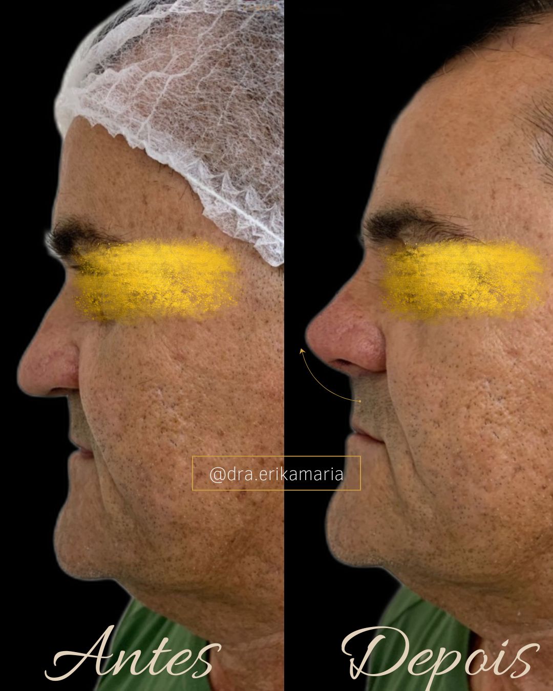 Foto 2 de Dra. Erika Maria- Harmonização Facial / Bichectomia