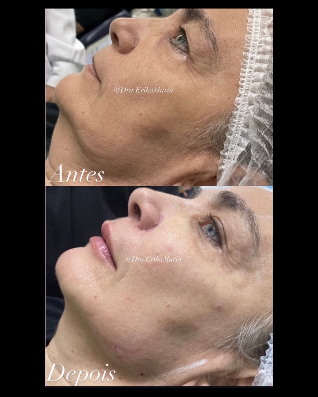Foto 3 de Dra. Erika Maria- Harmonização Facial / Bichectomia