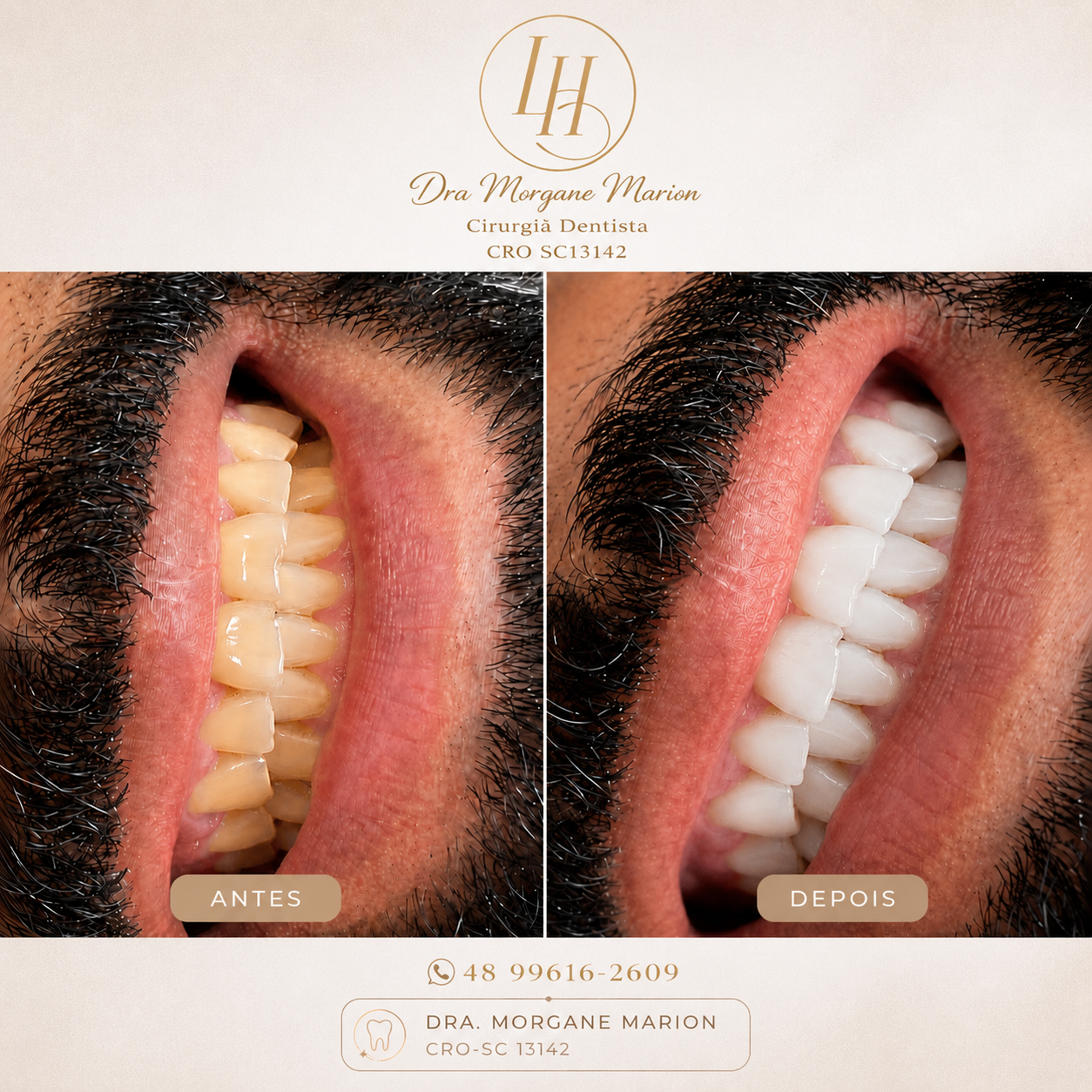 Foto 3 de Dentista Dra. Morgane Marion ( Endodontia com Microscopia, Harmonização facial e Alinhadores Invisíveis)