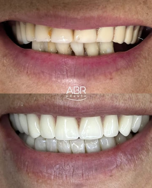 Foto 2 de ABR Odonto | Clinica Odontológica | Implante Dentário | Prótese Dentária | Lentes em resina