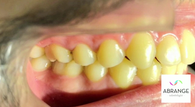 Foto 3 de Abrange Odontologia e Saúde | Implante Dentário | Invisalign | Centro | Pouso Alegre - MG