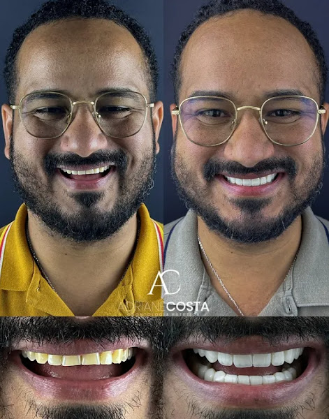 Foto 3 de AC Odontologia e Estética | Facetas em Resina | Dentista | Harmonização Facial