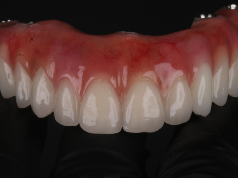 Foto 9 de Aclidan Odontologia - Estética Dental - Aparelho Ortodôntico - Implante sem corte