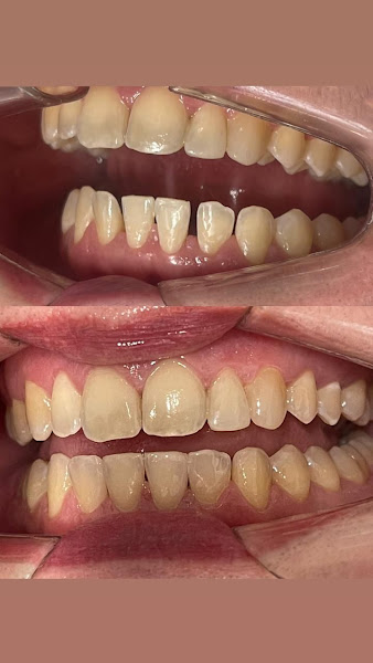 Foto 2 de AD Odontologia e Estética - Facetas de Resina em Santos - Facetas Dentais em Campo Grande
