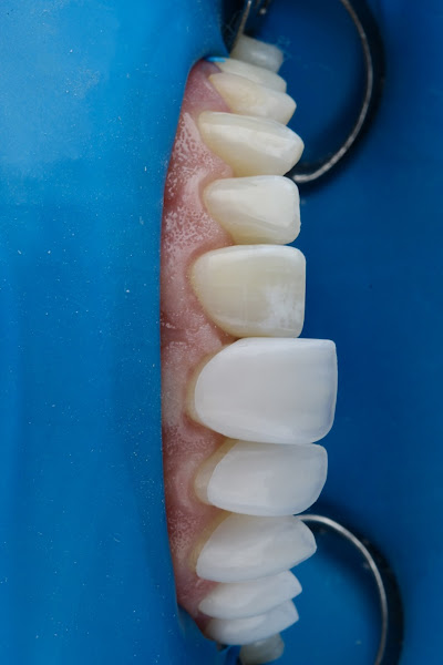 Foto 3 de Aline Demarchi - Lentes de contato dental | Passo Fundo