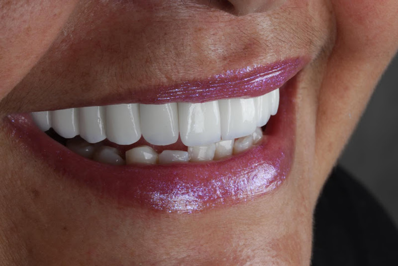 Foto 2 de Amorim Odontologia - Facetas dentais em São Vicente - Lente de Porcelana em São Vicente