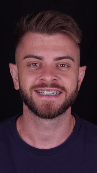 Foto 3 de Amorim Odontologia - Facetas dentais em São Vicente - Lente de Porcelana em São Vicente