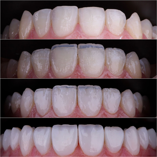 Foto 3 de Amorim odontologia - Lente de Resina em Pirituba - Facetas dentais Pirituba - Lente de contato dental