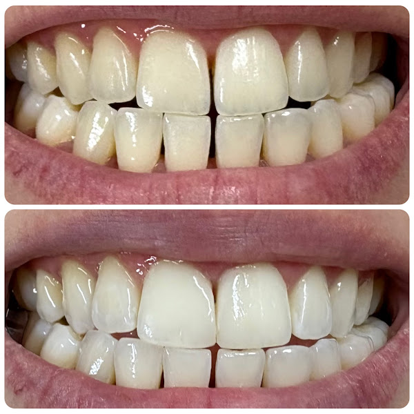 Foto 3 de AMS Odontologia — Clareamento Dental com LED Violeta | Facetas de Porcelana em Campinas