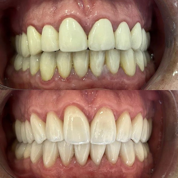 Foto 4 de Aniceto Odontologia em Pinheiros SP, Clareamento Dental, Restauração, Canal, Facetas Dentária, Lentes, Coroa Dental