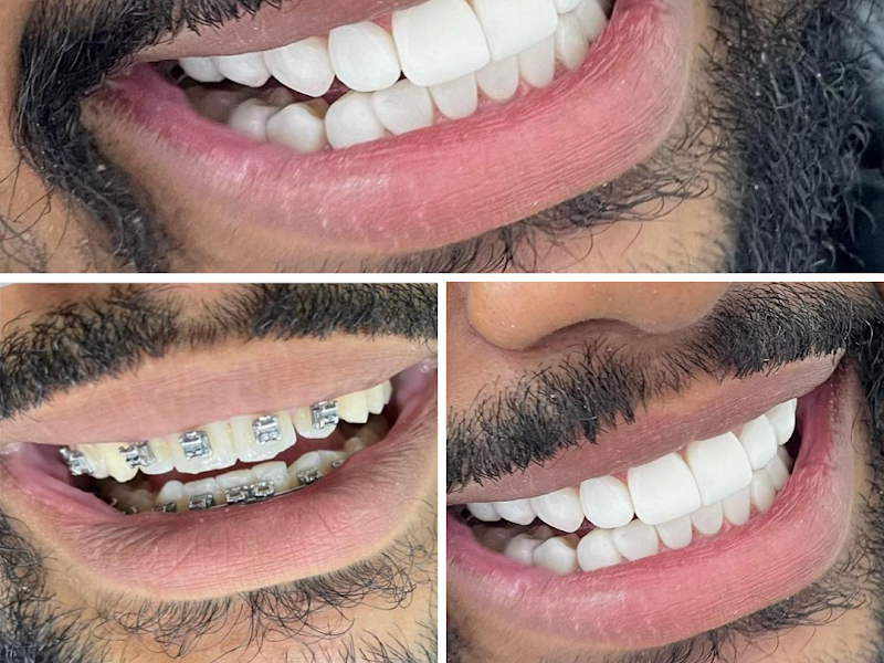 Foto 7 de Aniceto Odontologia em Pinheiros SP, Clareamento Dental, Restauração, Canal, Facetas Dentária, Lentes, Coroa Dental