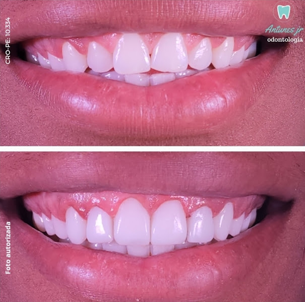 Foto 3 de Antunes Jr Odontologia / Facetas em Resina Recife / Dentista