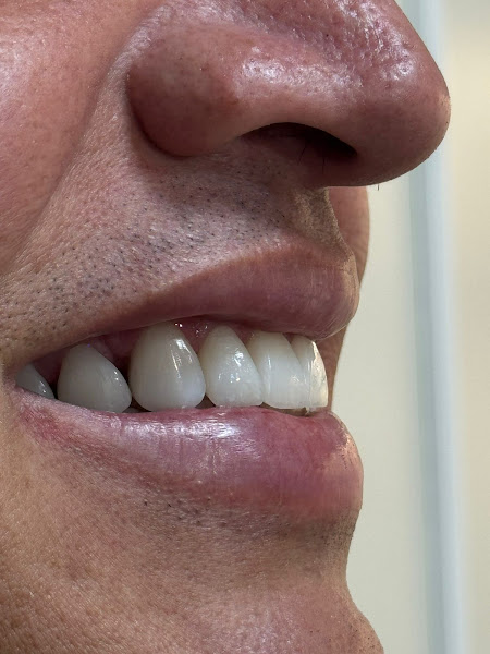 Foto 3 de Ardom Odontologia | Dentista em Várzea Grande | Dra. Jacqueline Del Grossi | Facetas em Resina | Estética Dental