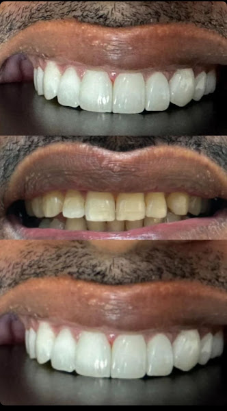 Foto 4 de Ardom Odontologia | Dentista em Várzea Grande | Dra. Jacqueline Del Grossi | Facetas em Resina | Estética Dental