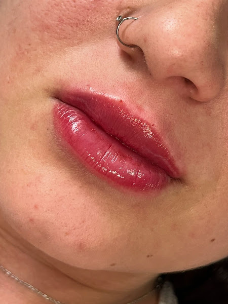 Foto 3 de ARQUITETURA LABIAL by Dra Rafaela Crestani: Preenchimento Labial, Botox & Clareamento Dental