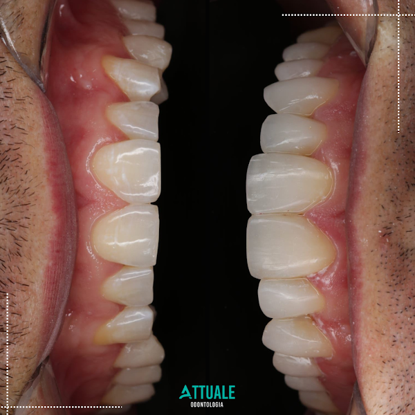 Foto 3 de Attuale Odontologia - Facetas de Resina e Porcelana