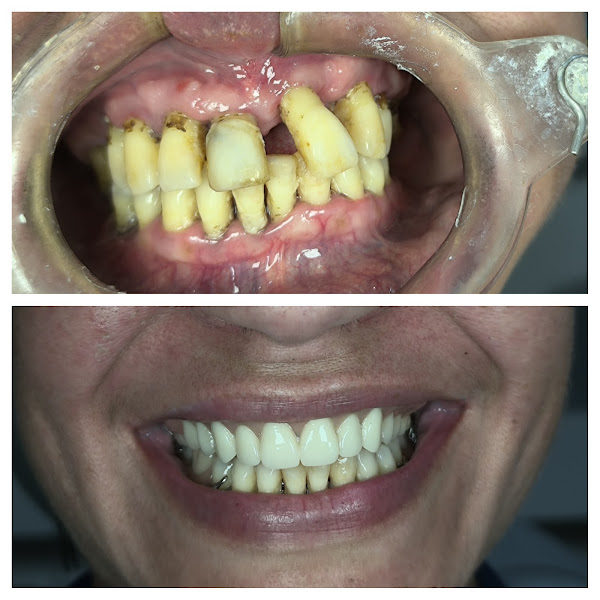 Foto 3 de Aura Odontologia Humanizada/Implantes/Lentes/Próteses/Clareamento