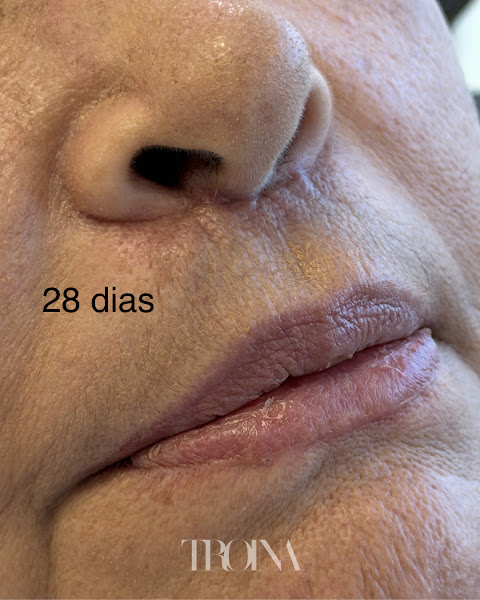 Foto 2 de Blefaroplastia - Dra Lais Troina