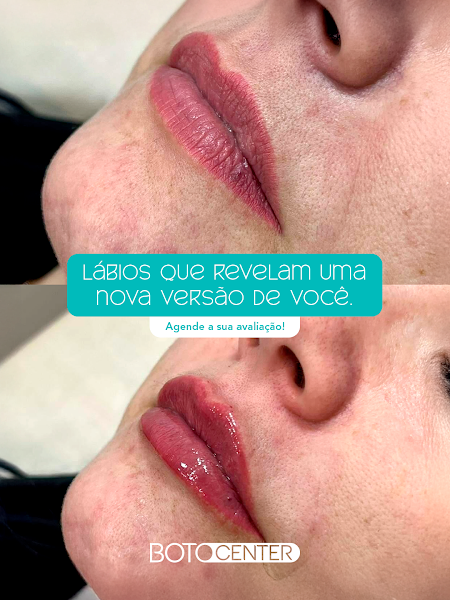 Foto 3 de Botocenter São José dos Campos: Clinica de Estética, São Paulo SP