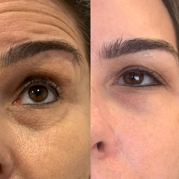 Foto 3 de Botox resende, Preenchimento labial - Dra Renata Faria Rodrigues