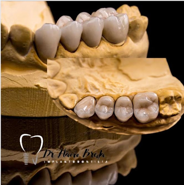 Foto 3 de BREDA ODONTOLOGIA - Implante dentário em São Bernardo do Campo/Protocolo carga imediata em poucas horas/Periodontista