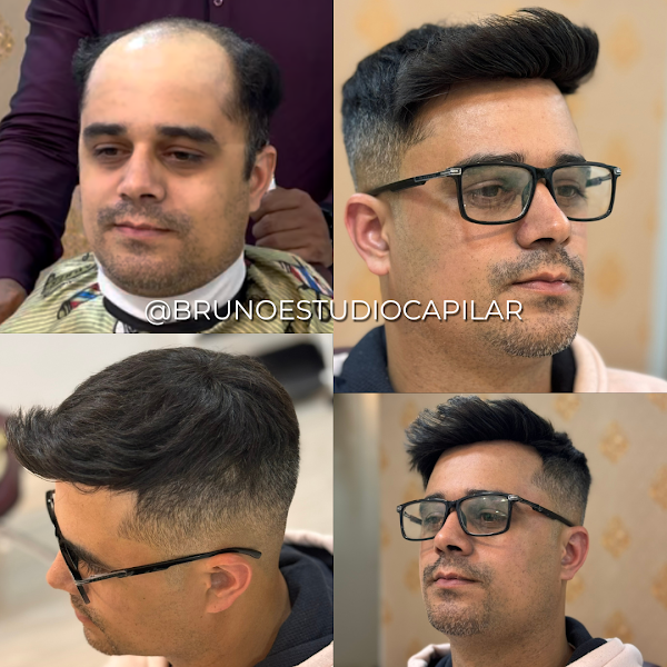 Foto 3 de Bruno e Martinelli Prótese Capilar