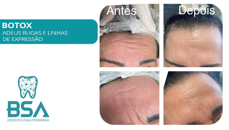 Foto 4 de BSA Odontologia - Facetas em Resina, Implante Dentário, Harmonização Facial e Clareamento Dental