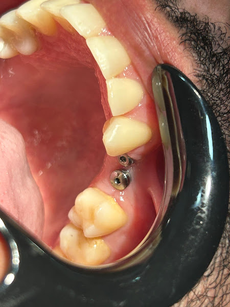 Foto 3 de Bv implantes