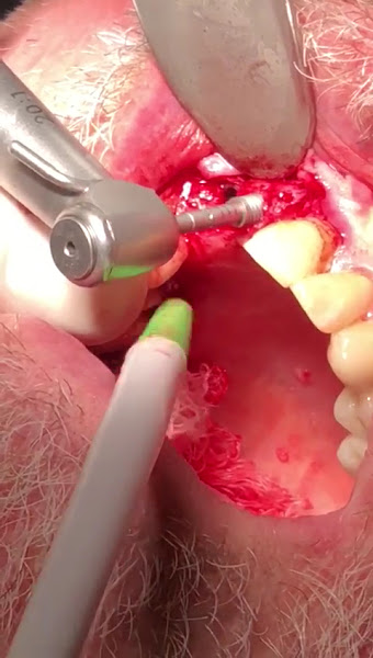 Foto 4 de Cárie Zero