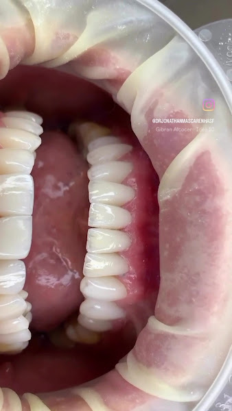 Foto 3 de Casal Dentista | Odontologia e Estética | Lipo de Papada em Rio Verde-GO