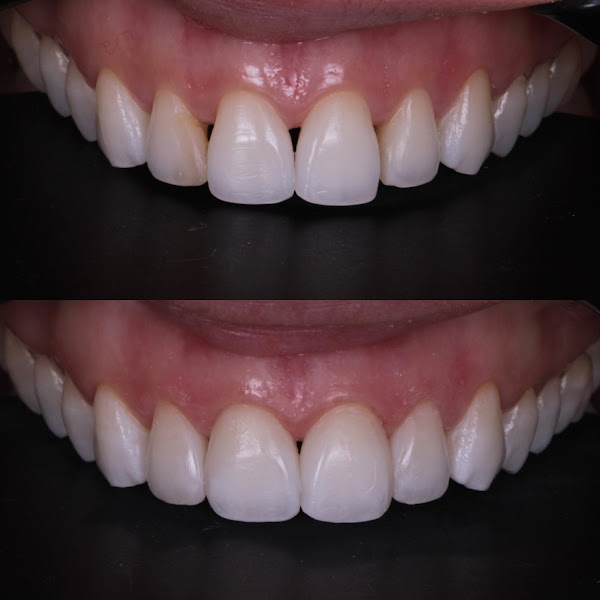 Foto 3 de CBClinic - Dra Caroline Bernardo da Silva | Faceta de Resina no Ipiranga