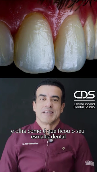 Foto 3 de CDS Odontologia Digital - Lente de contato dental em Tatuapé - Lente de porcelana em Tatuapé - Protocolo Fixo