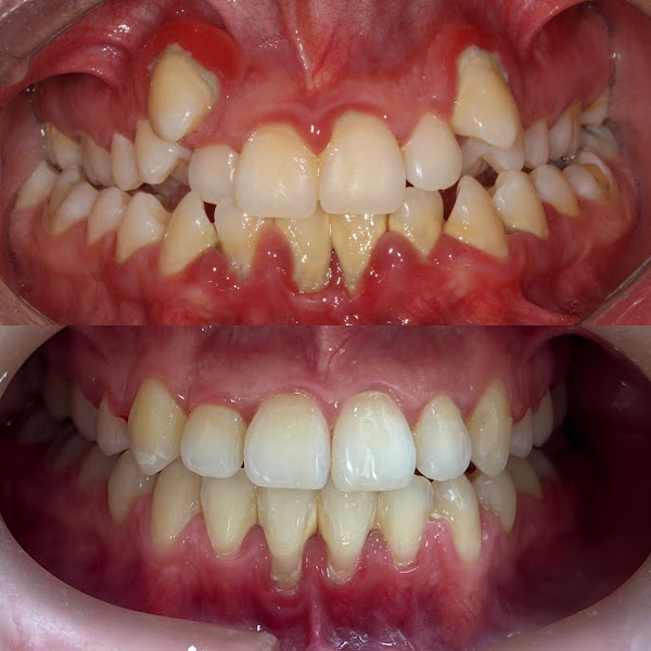 Foto 3 de Cibele Farias | Invisalign São Leopoldo | Aparelho Ortodôntico