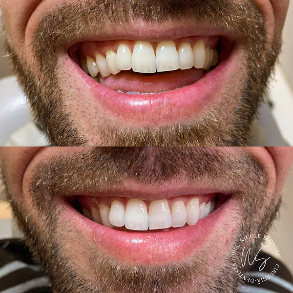 Foto 2 de Clareamento Dental| Dentista| Dra Nicole Slonski