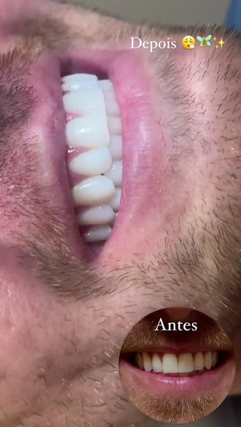 Foto 3 de Clareamento Dental| Dentista| Dra Nicole Slonski