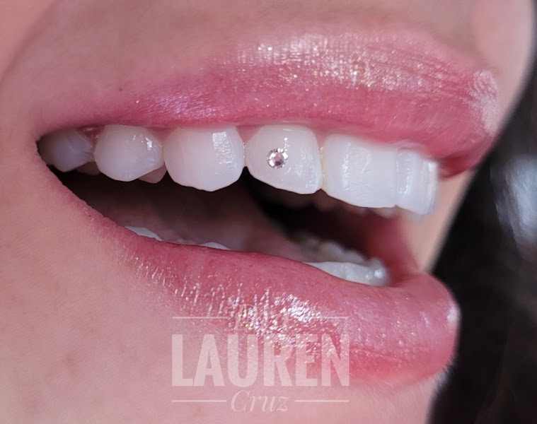 Foto 2 de Clareamento Dental | Dra. Lauren Cruz Dentista