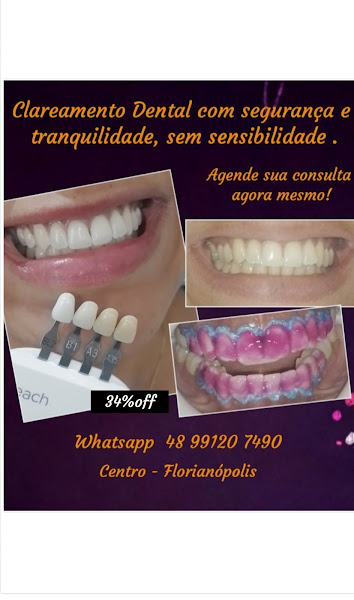 Foto 2 de Clareamento Dental & Facetas
