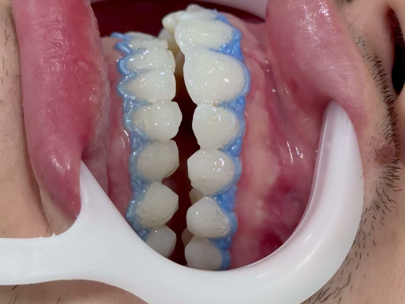 Foto 4 de Clareamento Dental Maringa - Dr Guilherme Tomon