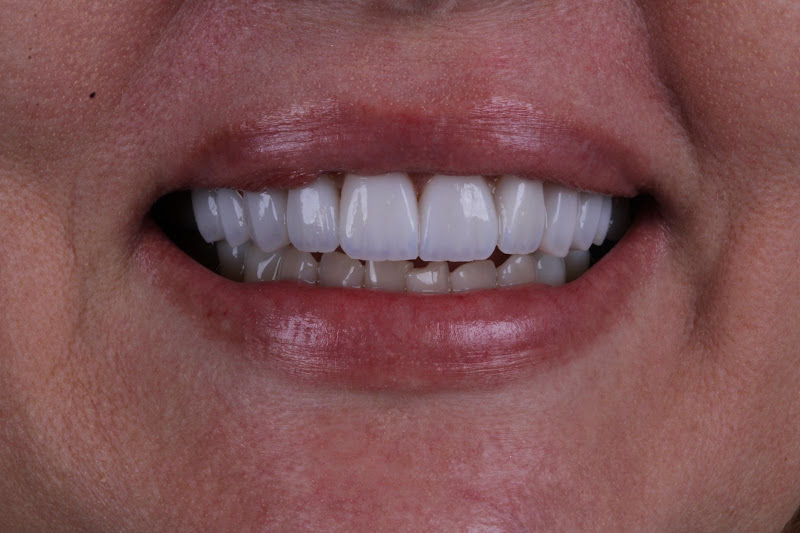 Foto 3 de Clerdent - Lentes de Contato Dental | Cirurgia de Implantes Dentários em Petrolina