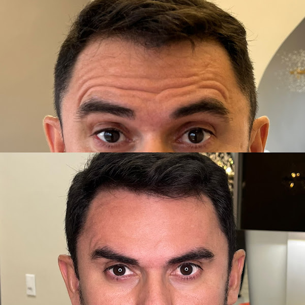 Foto 3 de Clínica Amanda Wurlitzer - Preenchimento Labial e Rinomodelação ( Harmonização Facial )