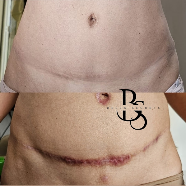 Foto 2 de Clínica B.Secrets - Cicatrizes , melasma , clareamento de axilas , queloides , cisto , estrias , camuflagem