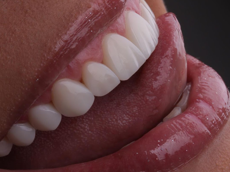 Foto 3 de Clínica Bethânia Luna - Facetas de Resina em João Pessoa