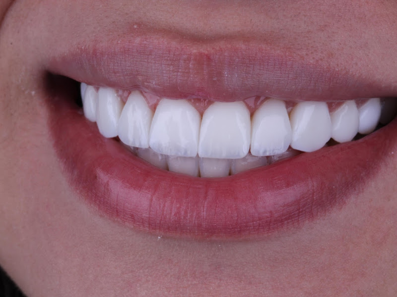 Foto 2 de Clínica Bitencourt - Facetas de Resina e Odontologia Estética