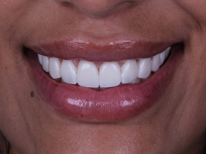 Foto 3 de Clínica Bitencourt - Facetas de Resina e Odontologia Estética