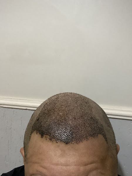 Foto 2 de Clínica Capelli | Transplante Capilar em Bauru