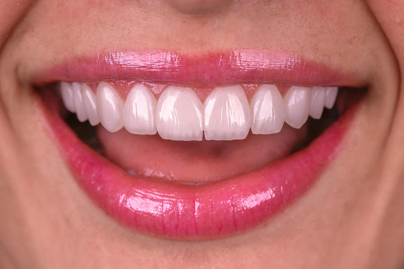 Foto 2 de Clínica Cipriano - Facetas de Resina