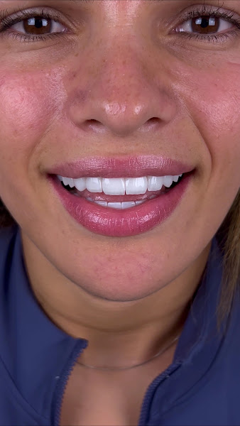 Foto 3 de Clínica Cipriano - Facetas de Resina