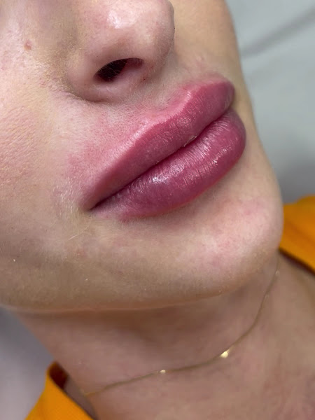 Foto 3 de Clínica de Estética Dra. Paola Ferreira / Botox / Preenchimento / Harmonização / Manchas / Rinomodelação / Lavieen