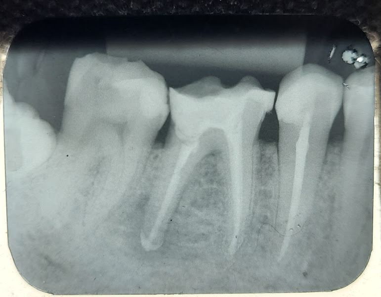 Foto 3 de Clínica DeLara | dentista, curitiba, implante, tratamento canal, clareamento, próteses, extração, ahú, cabral, juvevê
