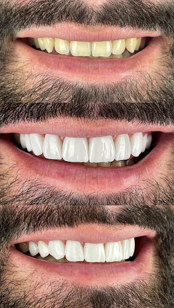 Foto 2 de Clinica Dr Felipe Araujo - Faceta de Resina em Barra da Tijuca - Lente de Contato Dental - Lentes de Porcelana